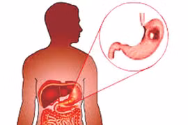 Nhận biết loại polyp dạ dày dễ ung thư