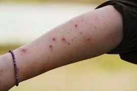 Xử lý vết côn trùng cắn, đốt