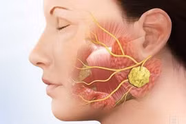Nguy cơ liệt mặt trong phẫu thuật u tuyến nước bọt 