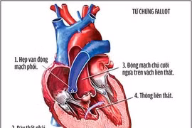 Có thai bị hẹp van động mạch phổi