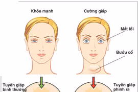  Bệnh Grave và Basedow