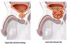 Tiền liệt tuyến sinh u