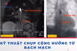 Can thiệp hệ bạch mạch cứu bệnh nhân tràn dịch