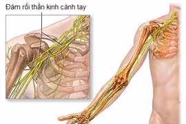 Mổ nối dây thần kinh