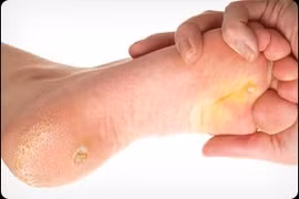 Xử lý vết chai chân
