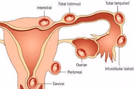 Chửa trứng cẩn thận ung thư di căn