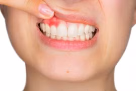 Cách chữa viêm chân răng có mủ hiệu quả, an toàn