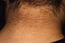 Điều trị bệnh gai đen ở người béo phì