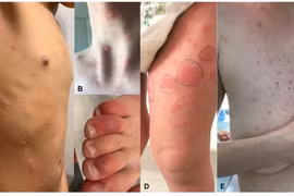 Tổn thương da ở bệnh nhân Covid-19