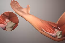 Đau dữ dội chân, tay có phải dấu hiệu cấp cứu của bệnh tim mạch?