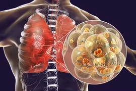  Những lưu ý để giữ lá phổi sạch