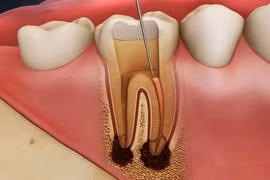 Biến chứng khủng khiếp chỉ từ viêm tủy răng 