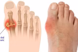 Bài thuốc hay phòng trị bệnh gút 