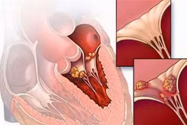 Viêm cơ tim cấp sau bị cúm