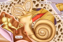 Chóng mặt cẩn thận u dây thần kinh thính giác
