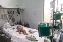 Đồng nhiễm Covid-19 và các bệnh truyền nhiễm khác như sốt xuất huyết thường có các triệu chứng tương tự, có thể chẩn đoán nhầm.