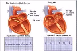 Rung nhĩ dễ đột quỵ 