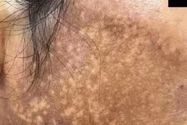 Da như bánh đa vừng đen vì kem tẩy trắng