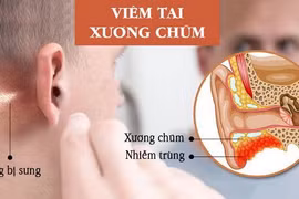 Nguy hiểm tính mạng vì chủ quan với viêm tai xương chũm