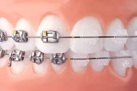  Muốn chỉnh răng sợ viêm nhiễm