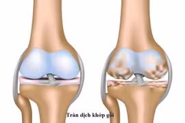 Có nên thay khớp gối?