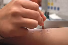 Dị ứng penicillin