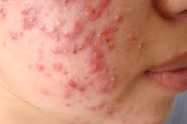 Đổi thuốc liên tục