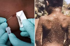 Virus đậu mùa khỉ nhiều đột biến không ngờ 