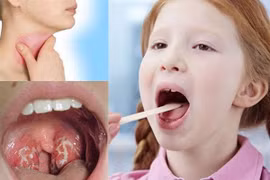 Trẻ viêm mũi họng dễ gây viêm đường tiết niệu