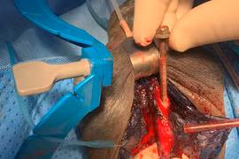 Một chiếc vít dài 6cm dính chặt vào niệu đạo người đàn ông 45 tuổi