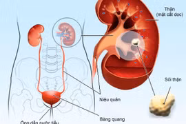 Uống thuốc không thể làm tan sỏi tiết niệu