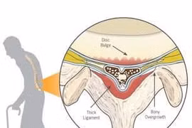 Các phương pháp chữa hẹp ống sống thắt lưng