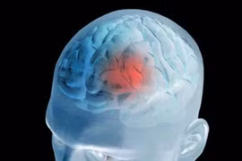 Tổn thương não gây đái tháo nhạt trung ương