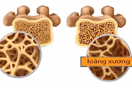 Những yếu tố ảnh hưởng đến mật độ xương