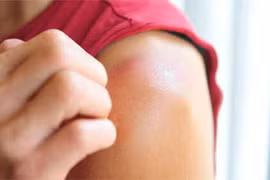 Dấu hiệu khi bị cháy nắng