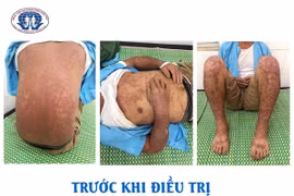 Cẩn thận với hội chứng Stevens - Johnson vì thuốc