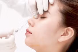 Hoại tử vì tiêm filler vùng mũi