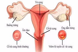 Lộ tuyến cổ tử cung có gây vô sinh?