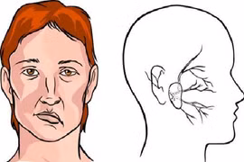 Cải thiện di chứng méo miệng sau tai biến mạch máu não bằng cách nào?