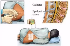 Tiêm Steroid ngoài màng cứng điều trị đau cổ và lưng