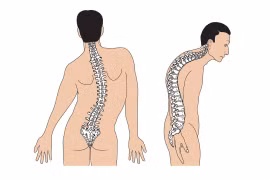 Vẹo cột sống không nên bi quan