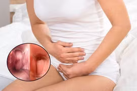 Viêm âm đạo không có thai