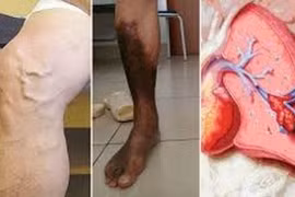Nguy cơ mắc bệnh tim khi bị hẹp động mạch chân 