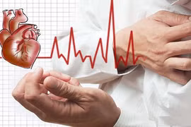  Nhồi máu cơ tim vì hội chứng động mạch vành cấp