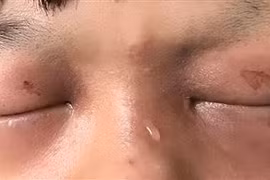  Cẩn thận chấn thương mắt do hỏa khí