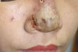 Ổ mủ mũi sau khi tiêm Filler