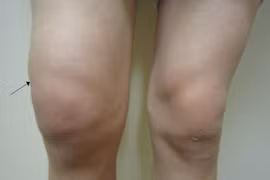 Tràn dịch khớp gối