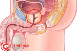 Biến chứng thường gặp của u xơ tiền liệt tuyến