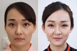 Tạo hình nâng gò má thấp