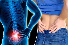 Cảnh báo điều trị đau lưng sai gây áp xe ngoài màng cứng